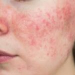 Diagnosis and Management of Chronic Skin Conditions