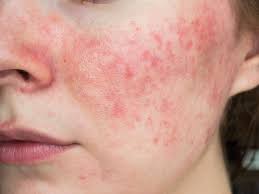 Diagnosis and Management of Chronic Skin Conditions