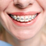 Exploring the Different Types of Braces