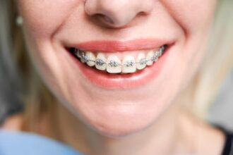 Exploring the Different Types of Braces