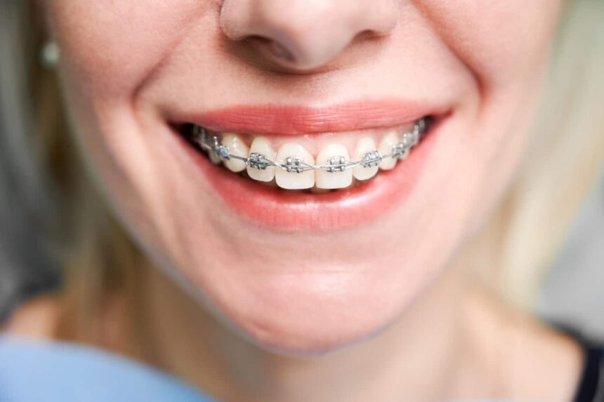 Exploring the Different Types of Braces