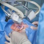 Exploring the Safety and Effectiveness of Laser Eye Surgery