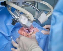 Exploring the Safety and Effectiveness of Laser Eye Surgery