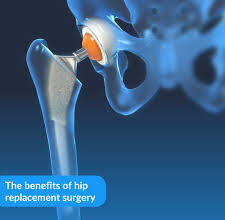 Factors to Review Before Undergoing Hip Replacement