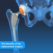 Factors to Review Before Undergoing Hip Replacement