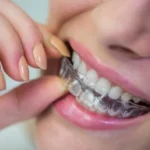 Invisalign Care Tips for Optimal Results