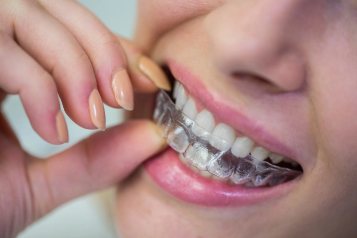 Invisalign Care Tips for Optimal Results