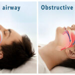 The Benefit of Managing Sleep Apnea