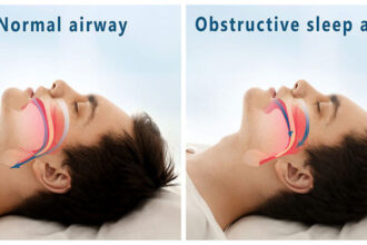 The Benefit of Managing Sleep Apnea