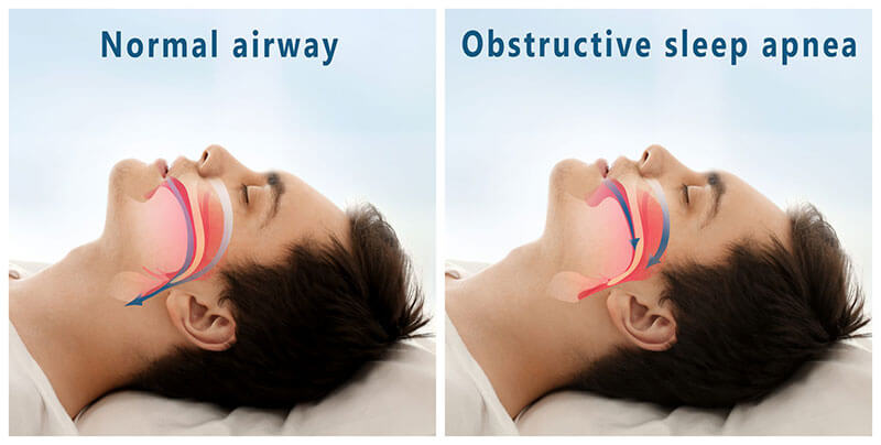 The Benefit of Managing Sleep Apnea