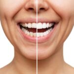 The Best Practices for Long-Lasting Teeth Whitening Results