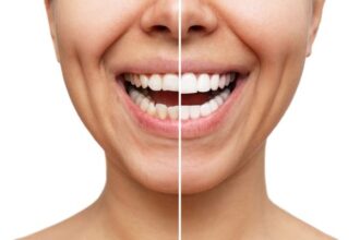 The Best Practices for Long-Lasting Teeth Whitening Results
