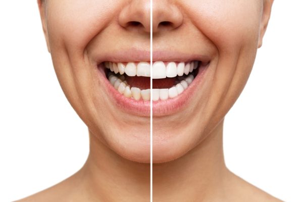 The Best Practices for Long-Lasting Teeth Whitening Results