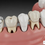 The Pros and Cons of Different Filling Materials