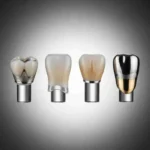 The Various Materials Used in Dental Crowns