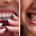 Understanding Different Orthodontic Treatments Available Today