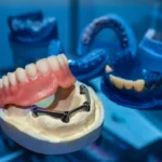 Why Dental Implants Are Considered the Gold Standard in Tooth Replacement