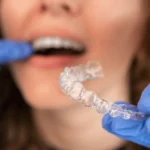 How to Care for Your Invisalign Aligners