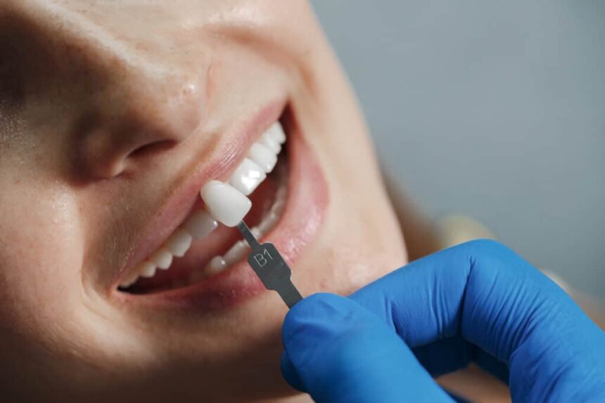 Regular Dental Check-ups After Getting Veneers