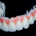 Understanding the All-In-X Dental Implant Procedure