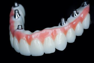 Understanding the All-In-X Dental Implant Procedure