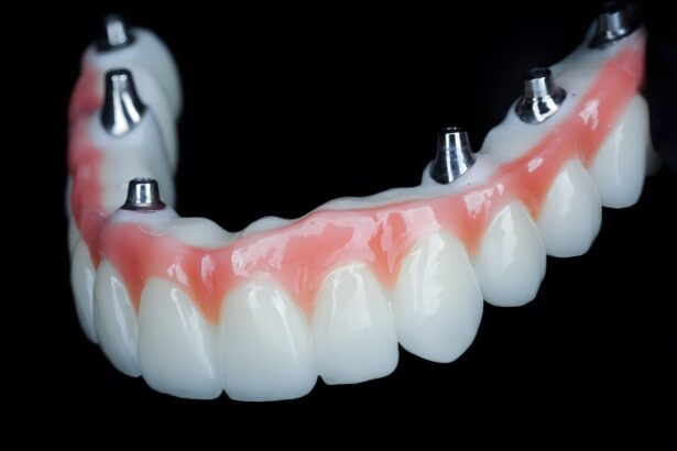 Understanding the All-In-X Dental Implant Procedure