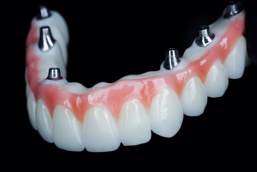 Understanding the All-In-X Dental Implant Procedure